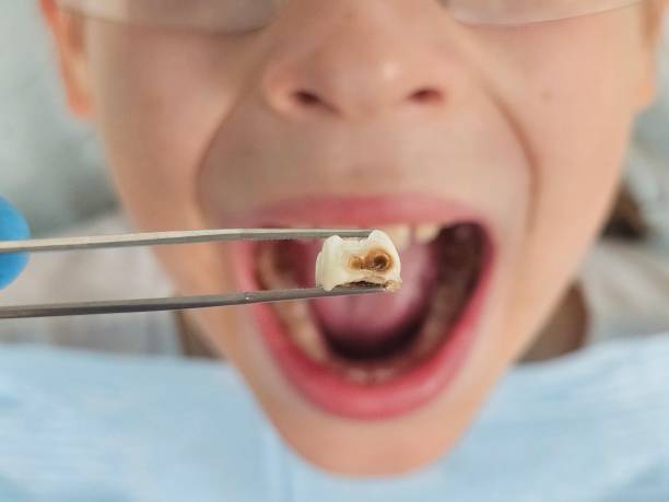 Best Emergency Dentist for Lost Fillings or Crowns in Forest City, PA